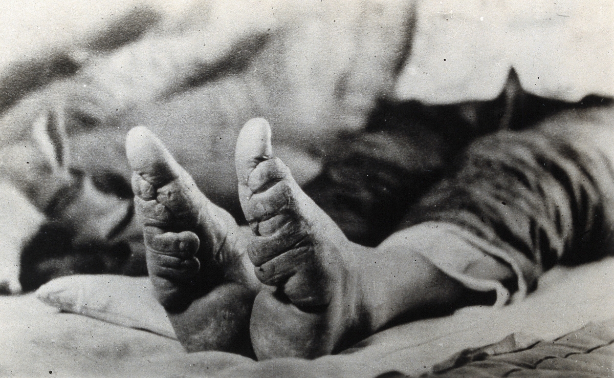 Jalgade sidumise tõttu deformeerunud hiina naise jalad. Foto: Wellcome Collection